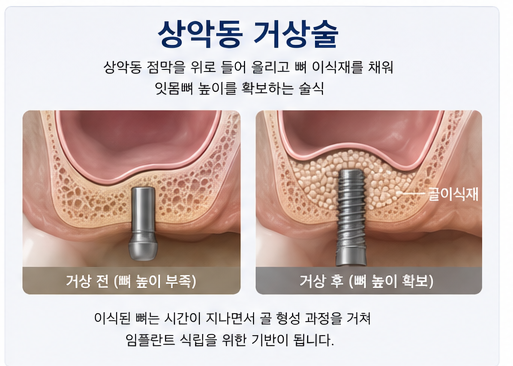 Yak-su Station Dental Clinic: When Is a Sinus Lift Necessary for Implants? image 3