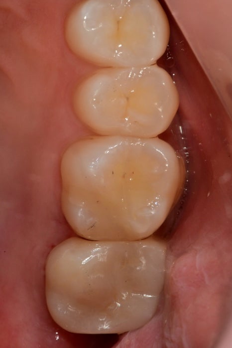장충동 치과, MTA를 이용한 신경치료 시 주의할 점( 크랙치아, 깊은 충치) 관련 이미지 4