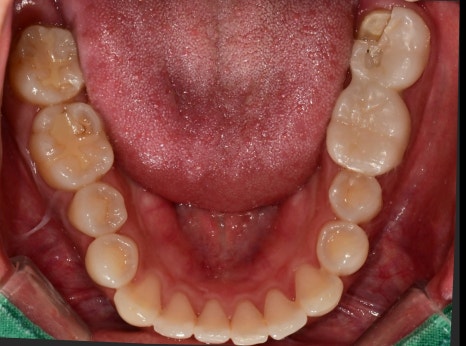 동대입구역 치과 이갈이 장치 제작이 필요한 경우(턱관절 통증) 관련 이미지 2