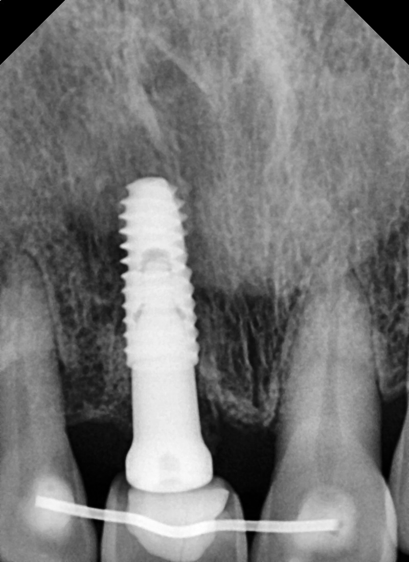 금호동 치과 앞니 임플란트 수술 후 빈 공간 임시로 회복하는 방법 관련 이미지 4