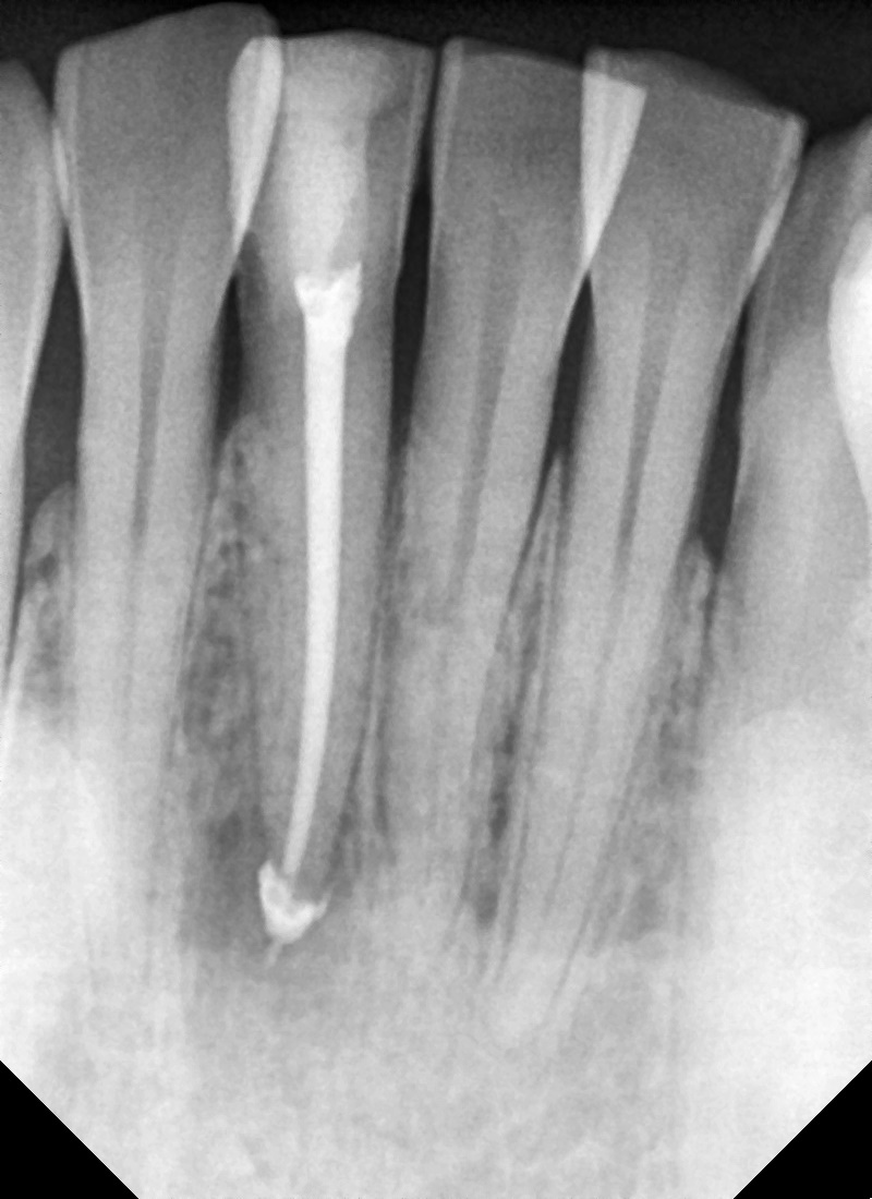 약수역 치과, 신경치료 시작 후 장기간 중단되었을 때 생길 수 있는 증상은?? 관련 이미지 4