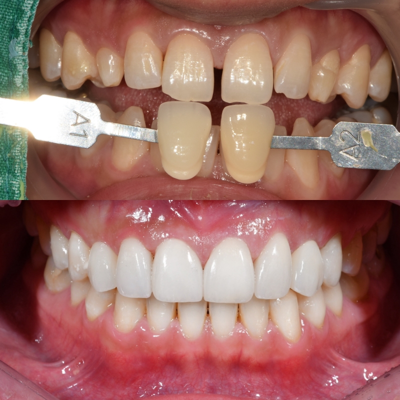 청구동 치과 앞니 라미네이트를 하는 이유 관련 이미지 9