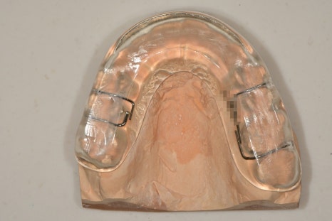 동대입구역 치과 이갈이 장치 제작이 필요한 경우(턱관절 통증) 관련 이미지 4