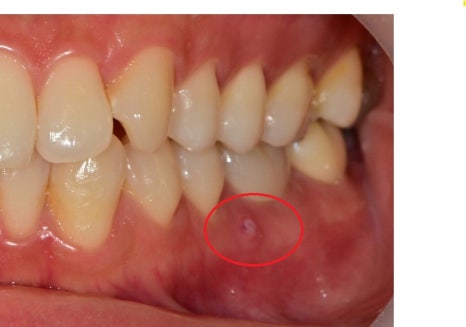 옥수동 치과, 신경치료 돼있는 치아 잇몸의 염증, 고름주머니가 생겼을 때 약을 먹어도 안 가라앉아요. ( 생기는 원인과 치료방법) 관련 이미지 1