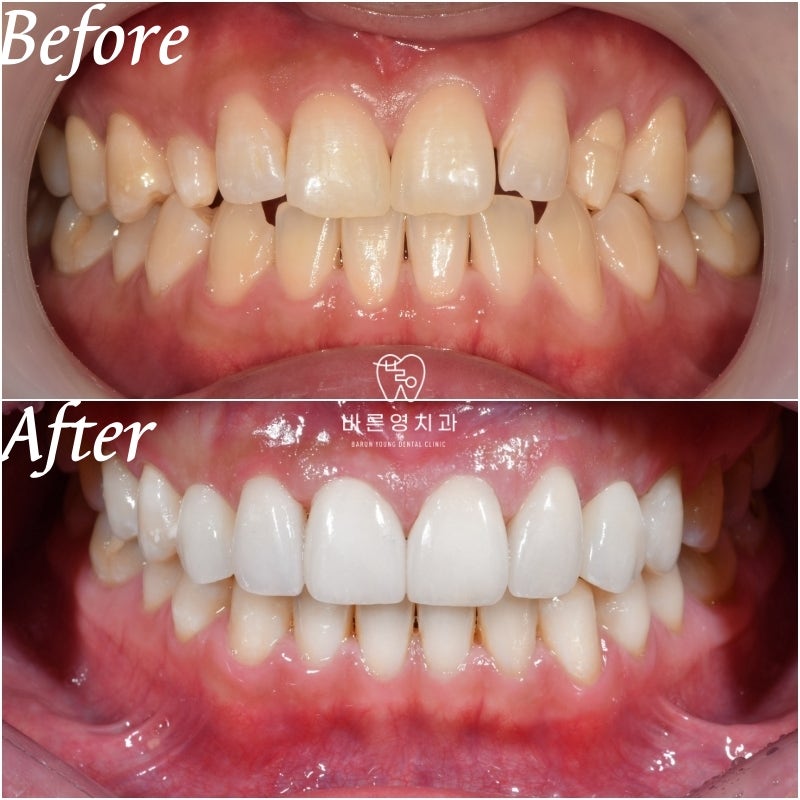 약수역 라미네이트 치과 선천적 왜소치 무삭제 치아 복원 관련 이미지 5