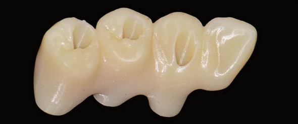 한남동 치과 디지털을 이용한 오차는 줄이고 편안함은 높이는 임플란트 관련 이미지 8