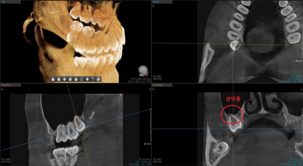 신당동 치과, 사랑니는 꼭 빼야 하나요?? 매복 사랑니 발치 시 유의할 점? (발치 후 통증 및 붓기) 관련 이미지 3