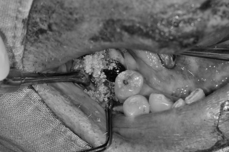 청구역 치과 치주염으로 다수의 치아가 흔들리는 경우(발치, 임플란트) 관련 이미지 8