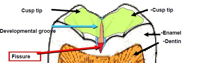 약수역치과 깊은 충치 신경치료 없이 치료하는 방법( MTA치료 ) 관련 이미지 3