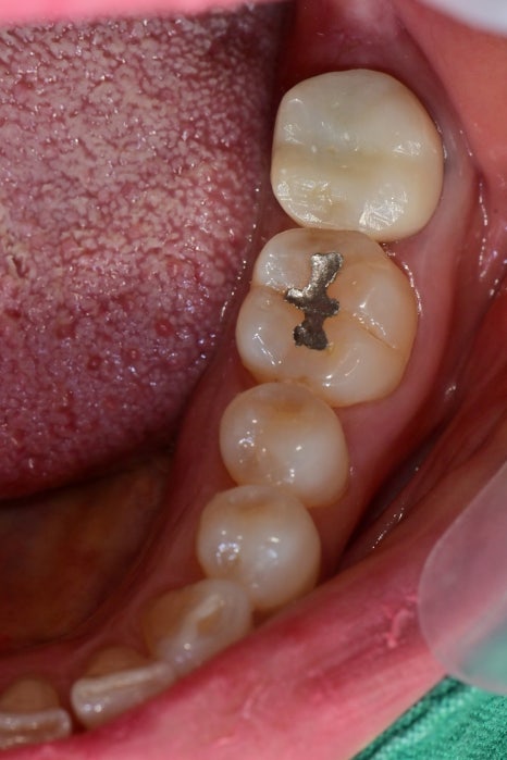 옥수동 크라운치료된 통증 있는 치아의 (재)신경치료 과정 관련 이미지 8