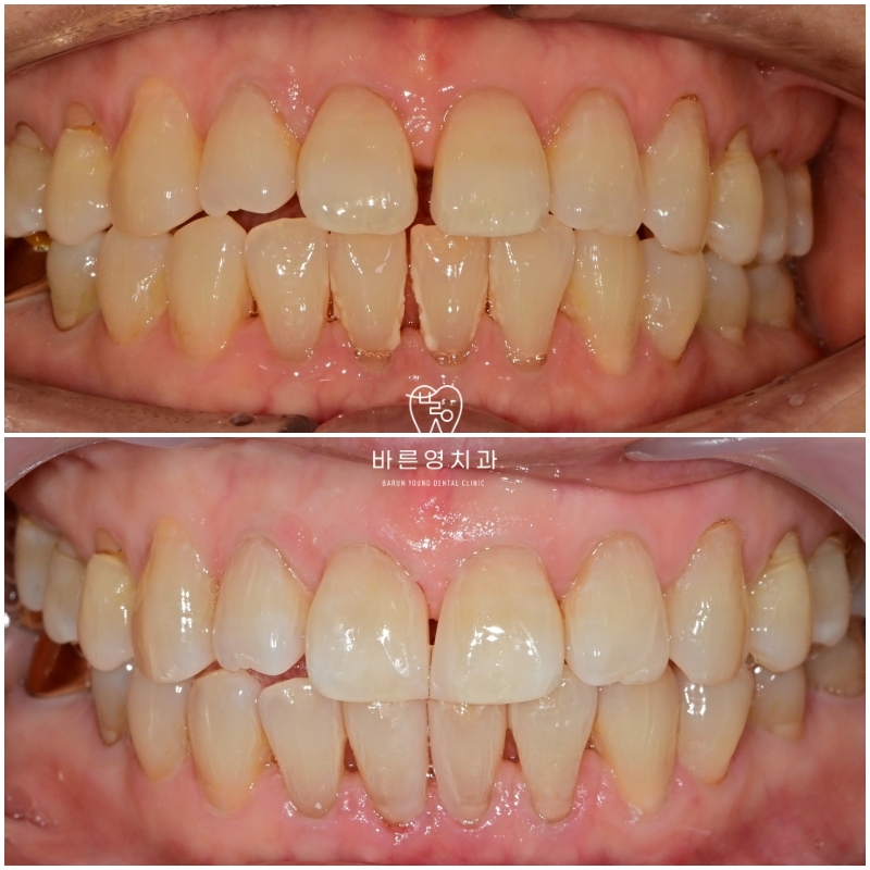 약수역 치과 벌어진 앞니, 금간앞니(크랙) 레진을 이용한 치료 관련 이미지 5