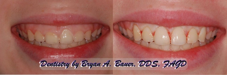 약수동 치과, 삐뚤어진 앞니가 충치가 생겨 치료 후 보철로 가지런한 치아 만들기 관련 이미지 4