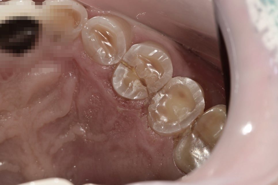 약수역 치과 크랙 치아 (금 간 치아) 관련 이미지 1