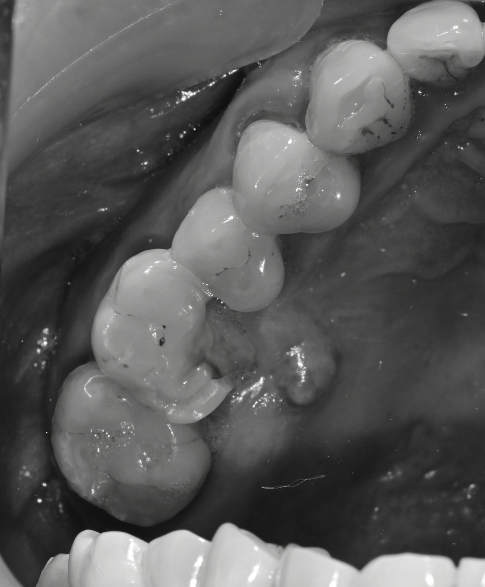 약수역치과, 뿌리염증 치아 신경치료하기( 금 간 치아) 관련 이미지 2