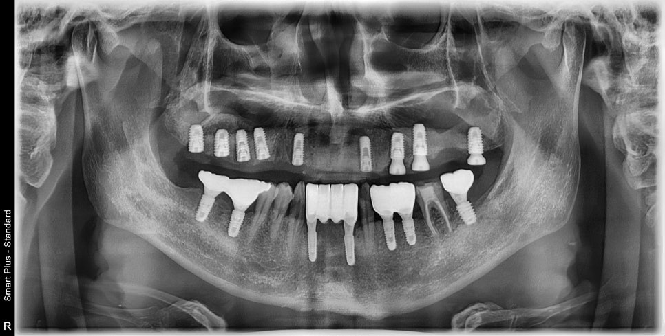 약수역 치과 비염 수술 후 상악동 임플란트 과정 관련 이미지 6