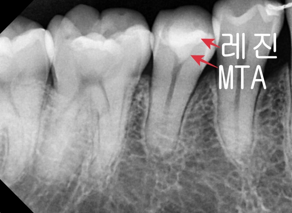 약수역치과 깊은 충치 신경치료 없이 치료하는 방법( MTA치료 ) 관련 이미지 8