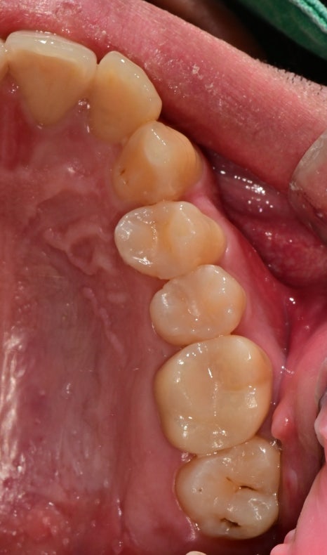 서울중구치과치료 신경치료받은 치아 크라운이 필요한가요? 관련 이미지 5