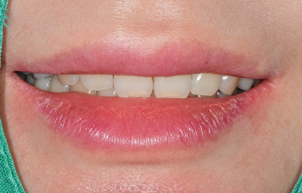 동대문 무삭제라미네이트 과거 교정한 치아가 웃을 때 안 보여 스트레스일 때 관련 이미지 8