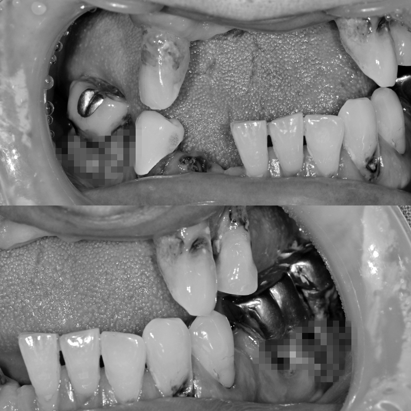 약수역치과 전체임플란트 진행과정 (상악동 거상술) 관련 이미지 3