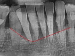 약수역 치과, 양치질 할때 피나고 냄새나는 잇몸병 관리 방법(워터픽, 먹는약) 관련 이미지 9