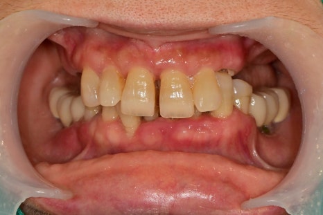신당 임플란트, 심을까 말까 고민되신다면?? (고난도 골이식 임플란트 기간 및 통증) 관련 이미지 6