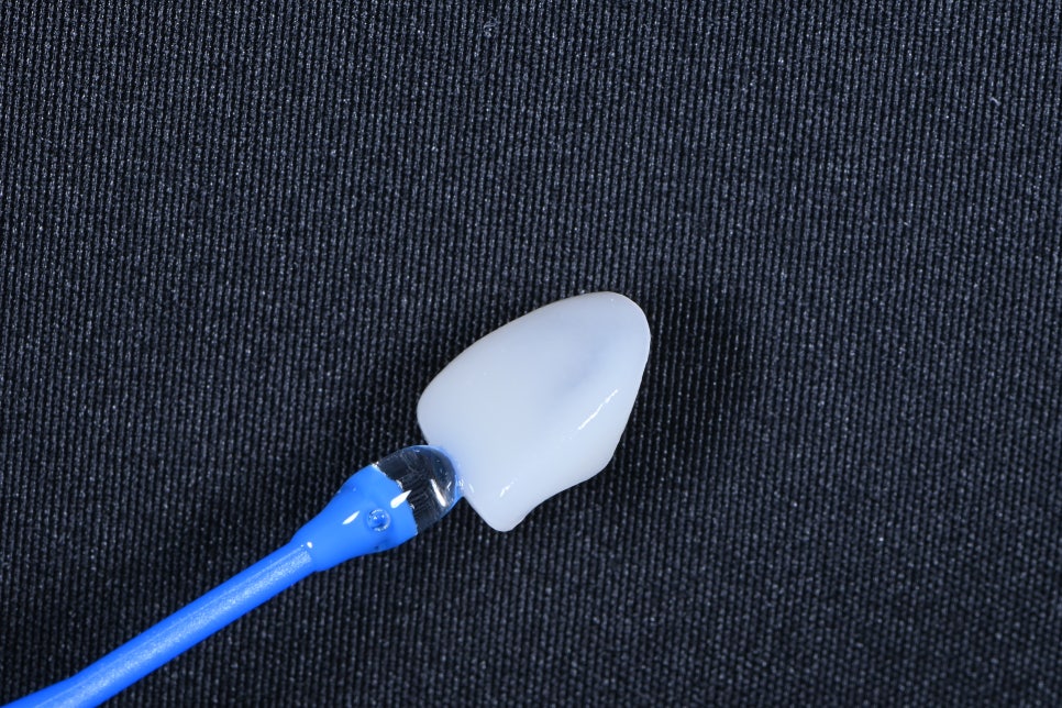 동대문 무삭제라미네이트 과거 교정한 치아가 웃을 때 안 보여 스트레스일 때 관련 이미지 6