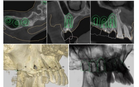 신당 임플란트, 심을까 말까 고민되신다면?? (고난도 골이식 임플란트 기간 및 통증) 관련 이미지 8