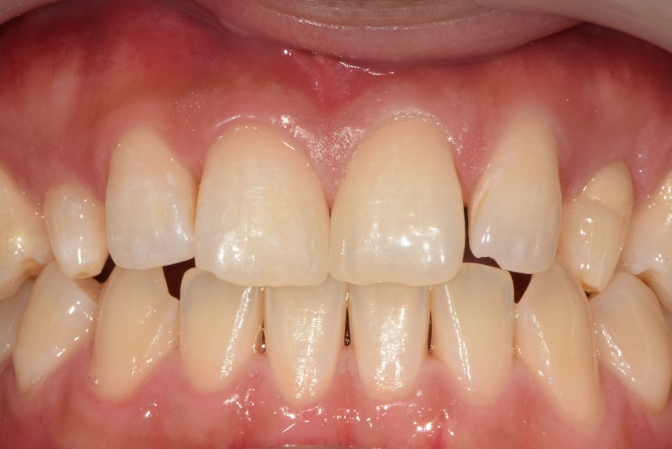 청구동 치과 앞니 라미네이트를 하는 이유 관련 이미지 4