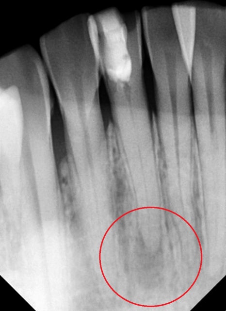 약수역 치과, 신경치료 시작 후 장기간 중단되었을 때 생길 수 있는 증상은?? 관련 이미지 2