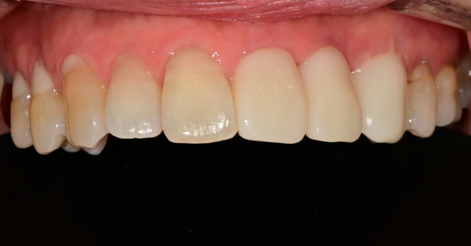 약수역 치과 오래된 앞니 크라운 재보철치료시 주의할 사항 관련 이미지 7