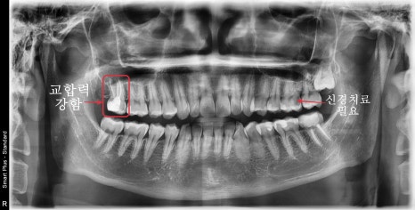 서울중구치과치료 신경치료받은 치아 크라운이 필요한가요? 관련 이미지 1