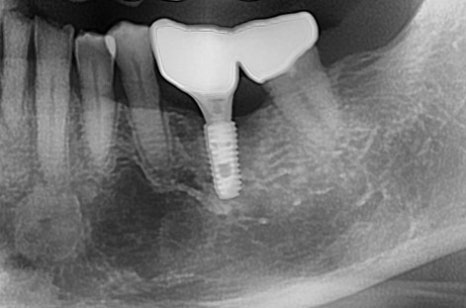 옥수동 치과, 신경치료 돼있는 치아 잇몸의 염증, 고름주머니가 생겼을 때 약을 먹어도 안 가라앉아요. ( 생기는 원인과 치료방법) 관련 이미지 7