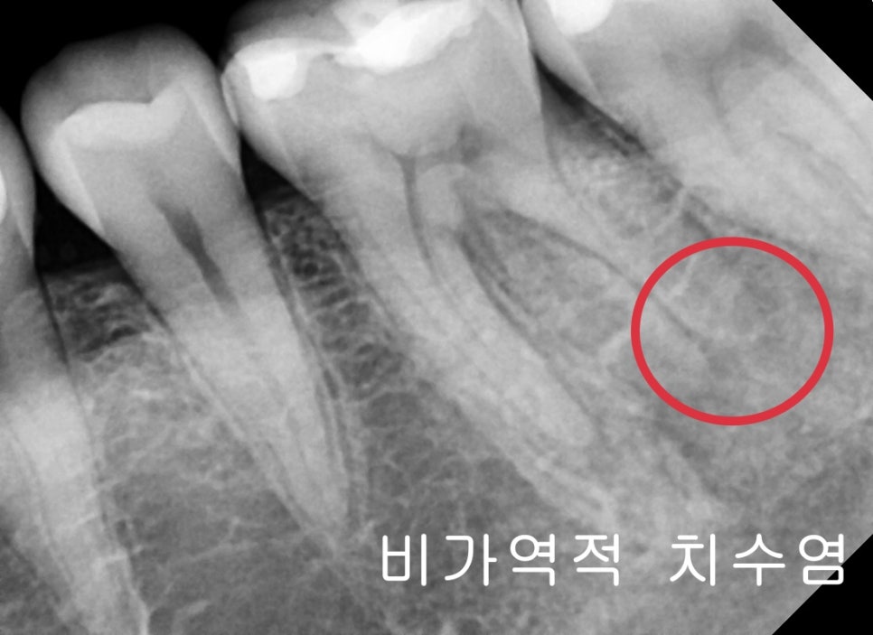 광희동 주변 치과 치아 크랙으로 인한 증상 신경치료 관련 이미지 4