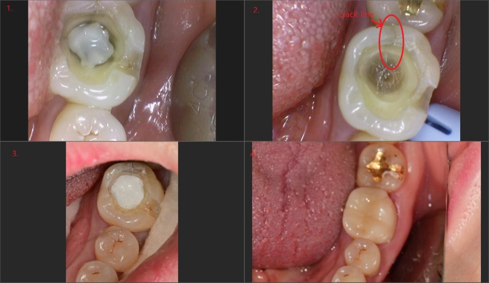 약수동 치과, crack 치아 (금간 치아)의 오래된 수복물 제거 후 치료방법( MTA, 깊은충치) 관련 이미지 3