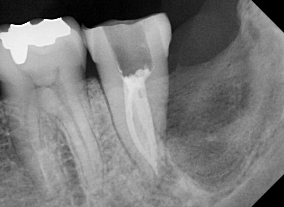 약수역 치과, 어려운 신경형태의 치아 신경치료 할때 주의할점 ( C형 근관, 신경관 찾기, 치아보존치료) 관련 이미지 7