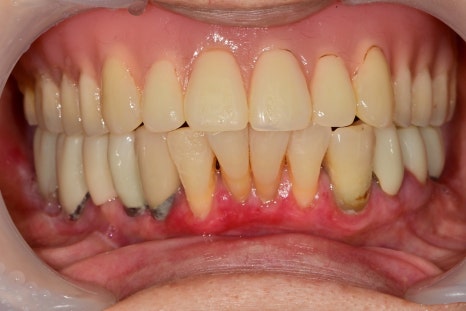 약수동 치과, 전체틀니 오래 쓰신분들 전체 임플란트 가능한가요??(치조골의 흡수양상과 모양) 관련 이미지 2