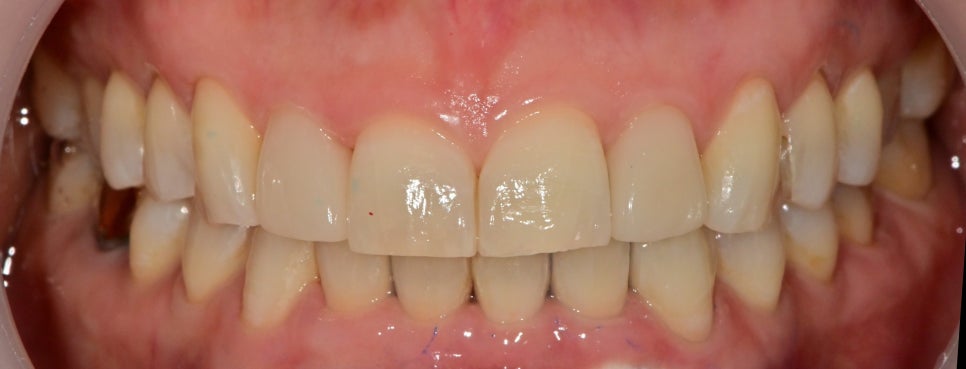 동대입구역 주변 치과 라미네이트가 깨지는 이유 관련 이미지 6