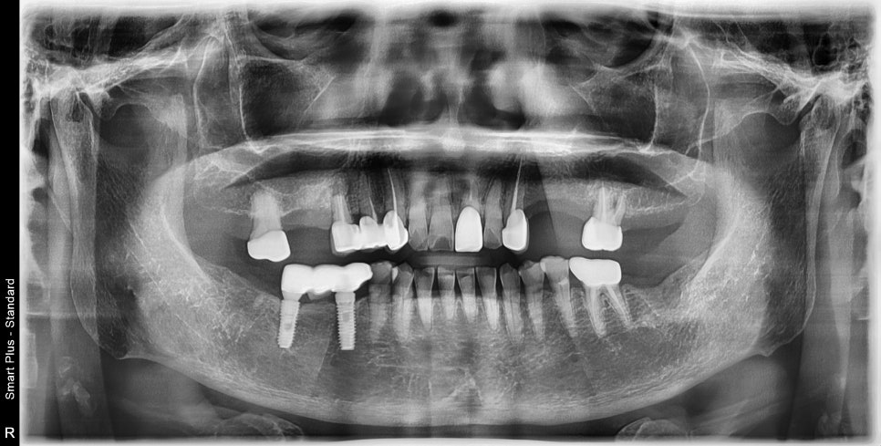 신당 치과 틀니보다 임플란트가 좋은 이유 관련 이미지 1
