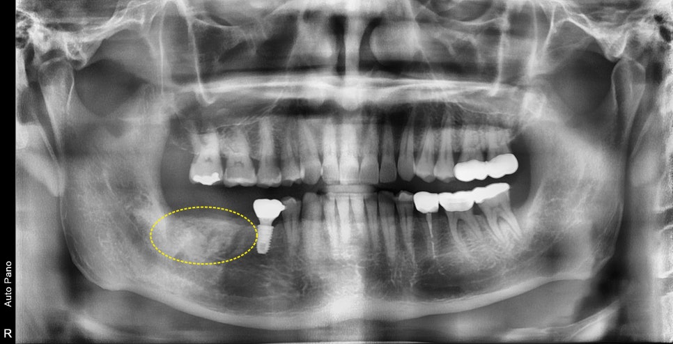 약수역 임플란트, 발치 후 임플란트 수술 언제 가능한가? 관련 이미지 3