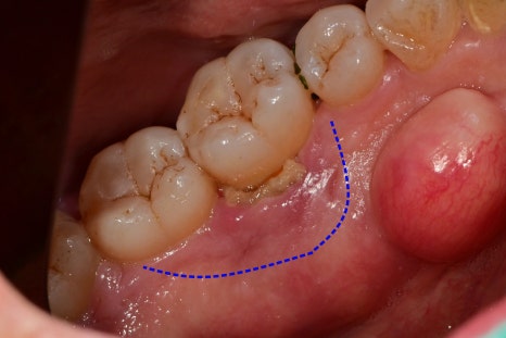 약수역 치과, 양치질 할때 피나고 냄새나는 잇몸병 관리 방법(워터픽, 먹는약) 관련 이미지 6