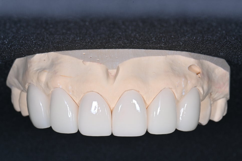 동대문 무삭제라미네이트 과거 교정한 치아가 웃을 때 안 보여 스트레스일 때 관련 이미지 4