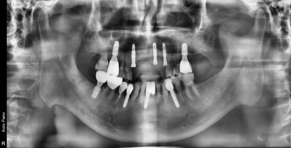 한남동 주변 치과 구강 스캐너를 이용한 가이드 임플란트 수술(무절개 수술) 관련 이미지 6