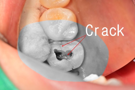 장충동 치과, MTA를 이용한 신경치료 시 주의할 점( 크랙치아, 깊은 충치) 관련 이미지 1