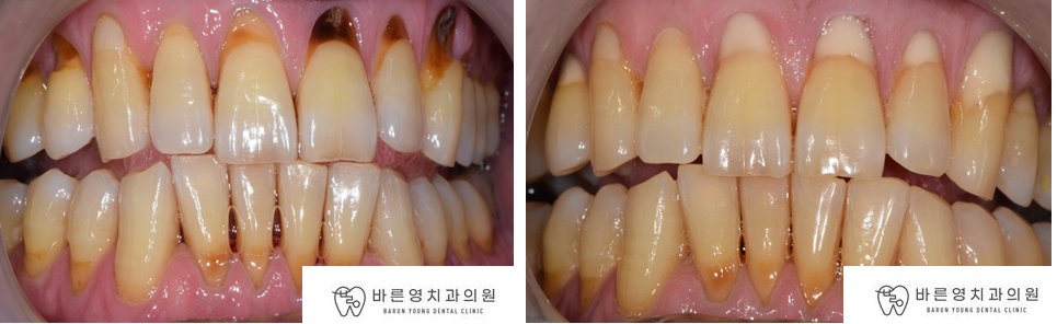 약수역 치과, 치경부마모증 치아에는 어떤 치료를 해야될까요??(시린이 치아의 원인과 해결방법) 관련 이미지 3