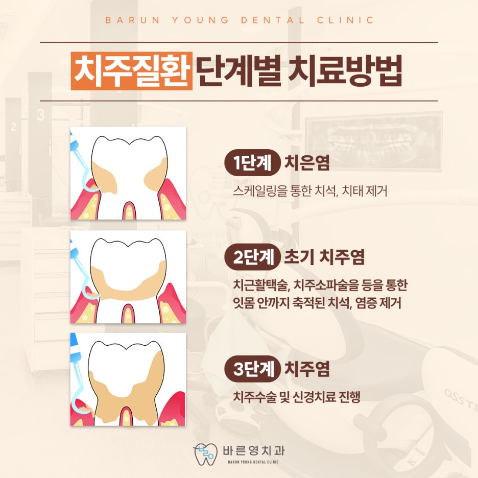 충무로치과 스케일링, 자꾸 피나고 찌릿하는 잇몸통증 이유는 치주질환? 관련 이미지 10