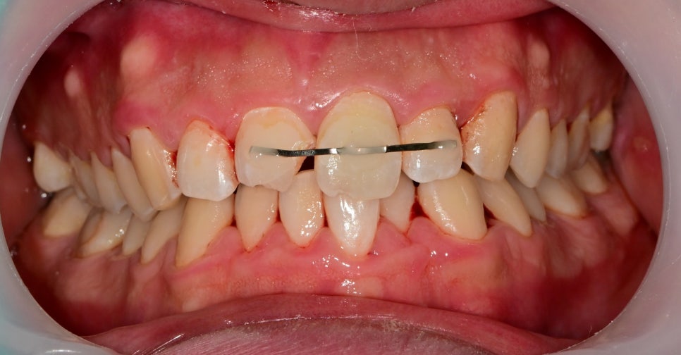 버티고개역 치과 앞니 외상에 따른 치료방법( 넘어져서 치아가 부러졌어요) 관련 이미지 6