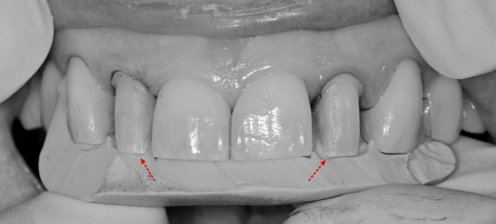 동대입구역 주변 치과 라미네이트가 깨지는 이유 관련 이미지 5