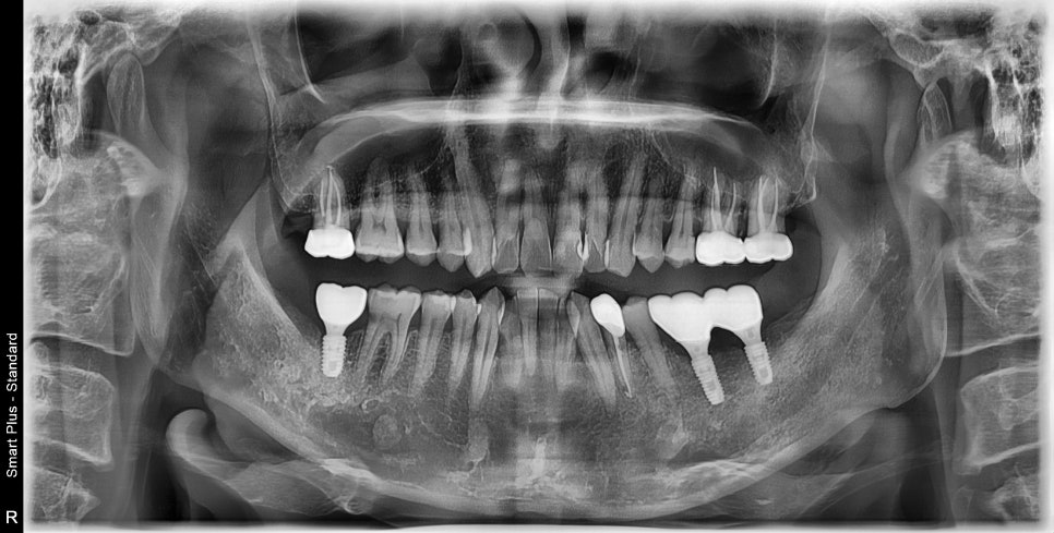 약수역 치과, 미뤄둔 임플란트 치료하기 (치과가 무서워요) 관련 이미지 8