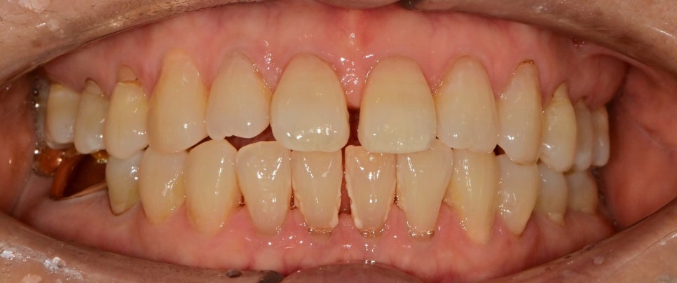 약수역 치과 벌어진 앞니, 금간앞니(크랙) 레진을 이용한 치료 관련 이미지 1