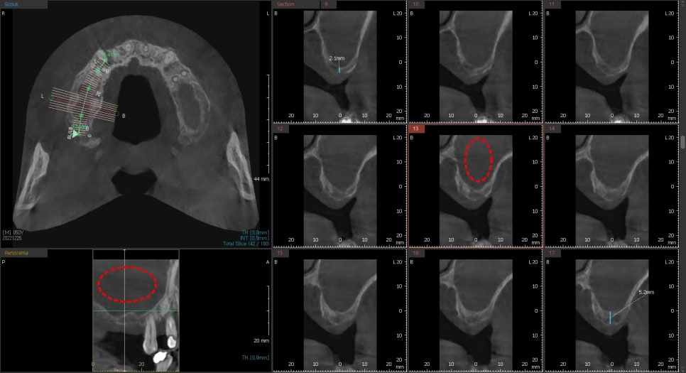 약수역 치과 비염 수술 후 상악동 임플란트 과정 관련 이미지 2